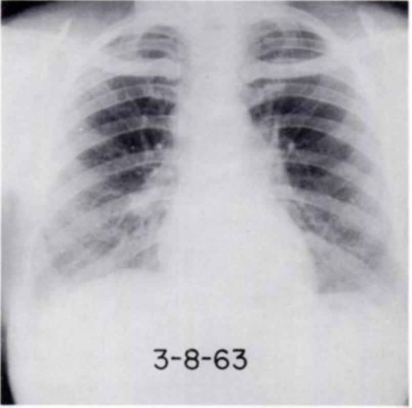434 SINGH AND FITZ PATRICK Diseases of the Chest 3-8-63 FIGURE 6: Prednisone discontinued. X-ray finding remains stable. No withdrawal effect of Prednisone was observed.