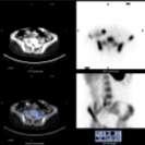 SPECT-CT : 67Ga 25 patients : ------------ 21 Lymphoma (HL-NHL) : Staging ReStaging ------------ 03 Infection