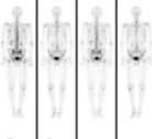 Limitation documented with HWK-4 : Whole-body in Oncology