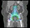 PET = Excellent for Viability Assessment Head and Neck Cancer : PET-CT Sofware Fusion for
