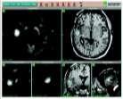 Brain Tumors with PET-MRI Definition of