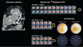PET-CTA Fusion In Cardiology PET-CTA Fusion In Cardiology Anatomy + Function Di Carli
