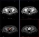 72) Bone Scan negative = 5 Diagnostic CT negative = 3 ProstaScint + = 8 / 10 = 80% -------- 6 = Prostate Bed recurrence -------- 1 = Extra-Prostate recurrence -------- 1 = LN + SPECT-CT >
