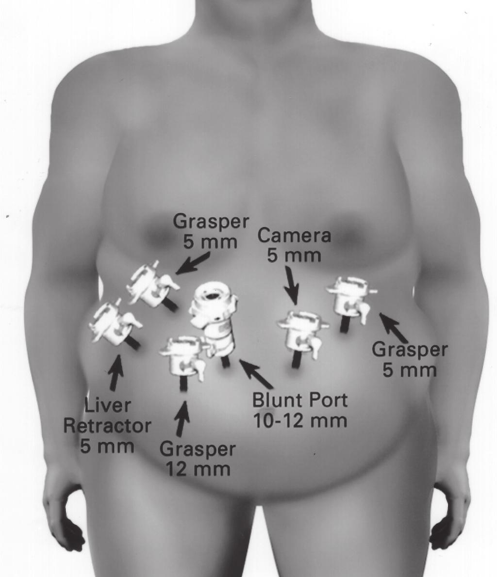 Laparoscopic Roux-en-Y Gastric Bypass for Recalcitrant Gastroesophageal Reflux Disease in Morbidly Obese Patient, Perry Y et al. from physician office scales or telephone interviews.