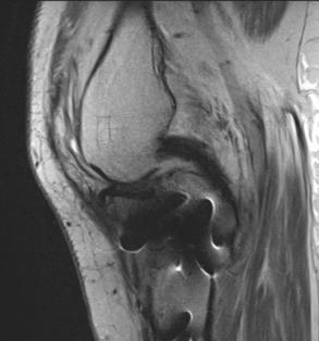 .. Evaluate ACL PCL Meniscus Posterolateral corner injury 16 y/o female with