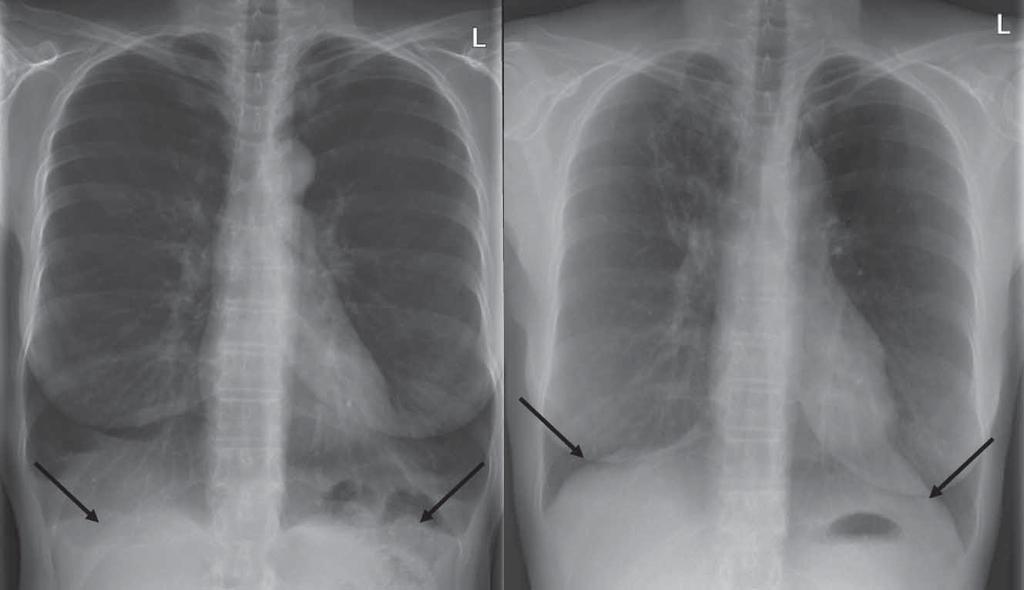 a b Figure 5. According to Weder et al (25) a) preoperative chest x-ray b) postoperative day is performed in patients with uniformly destroyed (vanished) lung.