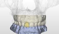 How? Examination and preparation The implant treatment starts with 3D examination of the available bone and significant anatomical landmarks, such as neighboring teeth and roots, as well as