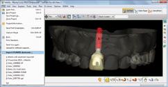 The online 3D editor allows adjusting of the Atlantis Abutment design if needed or detailed instructions can be added for the Atlantis design technician.