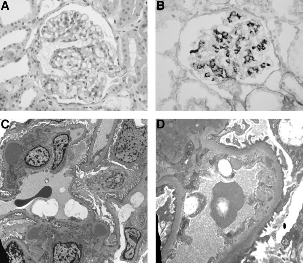 Clinicopathologic correlation in IgAN 11 Figure 1. (A) Glomeruli show a mild to moderate increase in mesangial cells and matrix.
