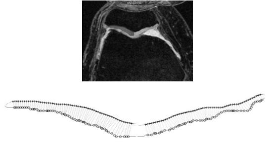 abnormal and/or prolonged stress Decreased cartilage thickness Decreased