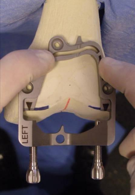 on the top for Large knees 1/ Position the Positioning Frame on the anterior resection.