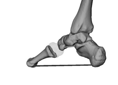 9. Inflammation of the plantar fascia a ligament on the plantar