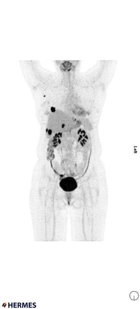 18F- FDG PET/CT for breastcancer staging Where is the