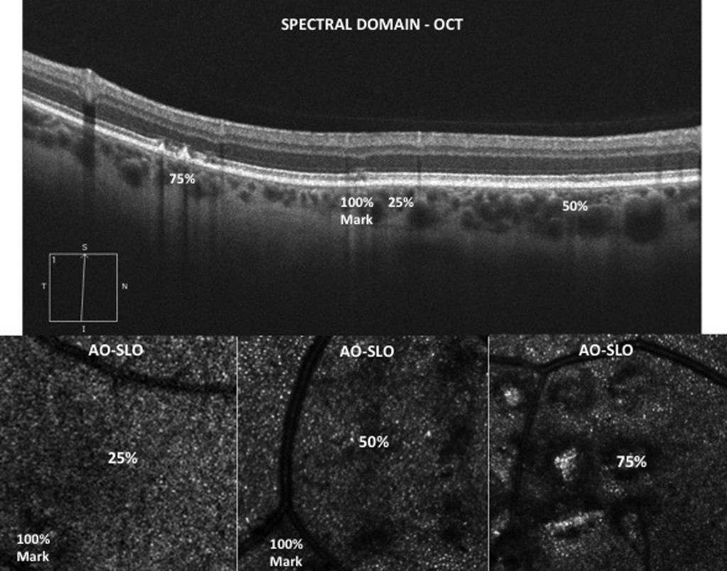 Figure 4. Laser burns 9 months after treatment. of threshold power, whereas the 50% and 75% lesions showed initial outer-retinal damage (SD-OCT) and damage to photoreceptor arrays (SLO-AO) (Figure 3).