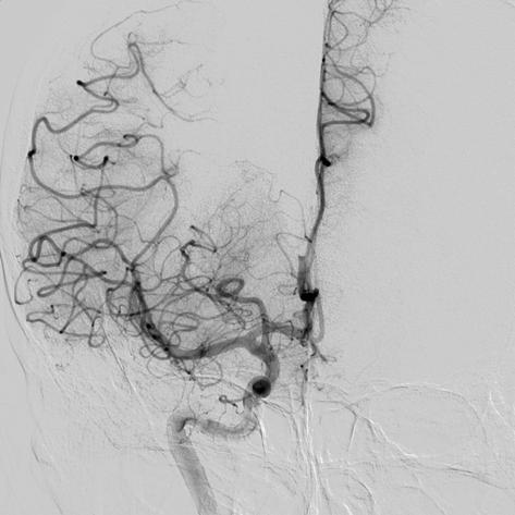 GYU-SEONG BAE ET AL A B A C D C Fig. 2. Initial gradient echo image of magnetic resonance image (MRI) shows a clot in the right middle cerebral artery (MCA) (A).