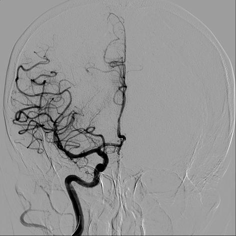 After retrieval of the Solitaire AB stent, angiogram shows nearly complete recanalization of the right MCA and a newly observed occlusion in the previously uninvolved distal right anterior cerebral