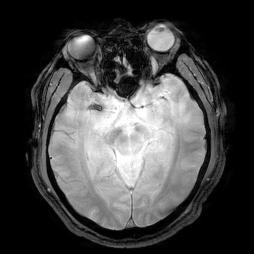 Initial angiogram shows partial occlusion of the middle cerebral artery (MCA) inferior branch in a patient with a progressed MCA superior branch territory infarction on a diffusion-weighted magnetic