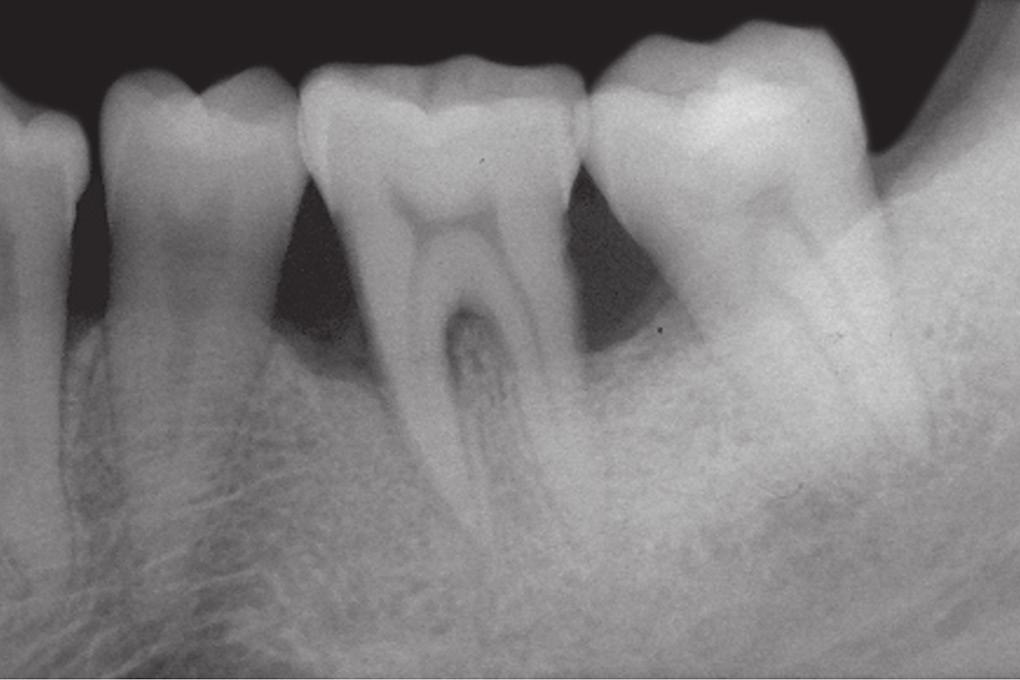 Nitika N Bembi et al Table 2: and mean s in probing pocket depth, clinical attachment level and gingival recession between groups I and II at different intervals Probing pocket depth Clinical