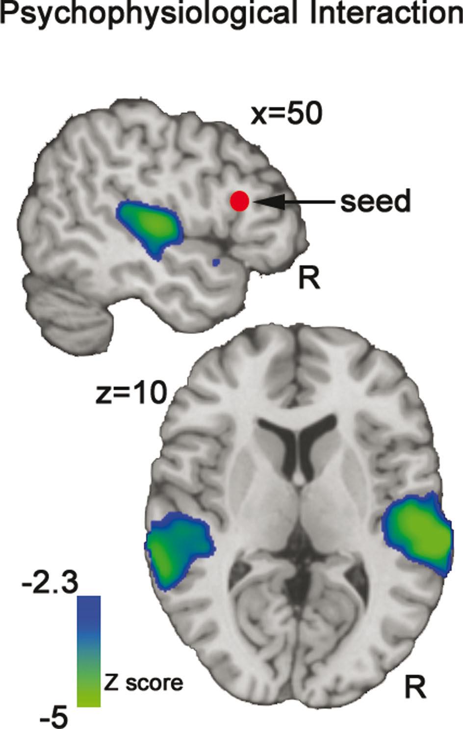 FIGURE 6 Psychophysiological (PPI). This functional connectivity analysis map illustrates the negative interaction between ZCUE and the mean timeseries of IFG seed region (red sphere).
