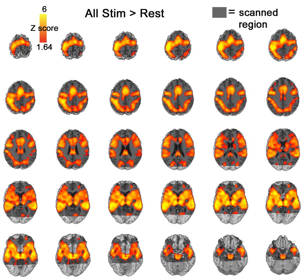 FIGURE 2 All stimuli > rest. Activation presented at an uncorrected p < 0.05 threshhold. Grey shadow represents scanned regions of the brain.