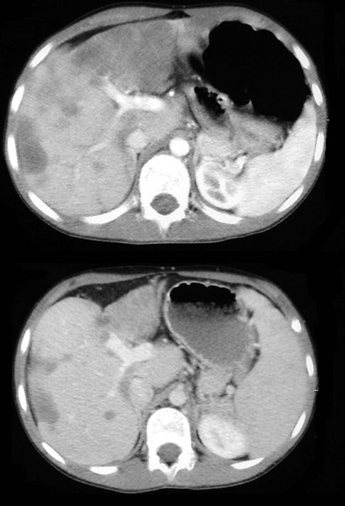 Liver transplantation for primary malignat liver tumours in children Low grade malignancy Epitheloid Haemangioendothelioma 11 Yrs old Abdominal pain Hepato-splenomegaly Multifocal liver
