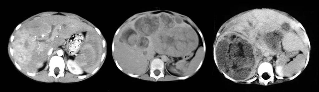Liver transplantation for primary liver tumours in children Hepatocarcinoma RARE in children Presentation A: small HCCA