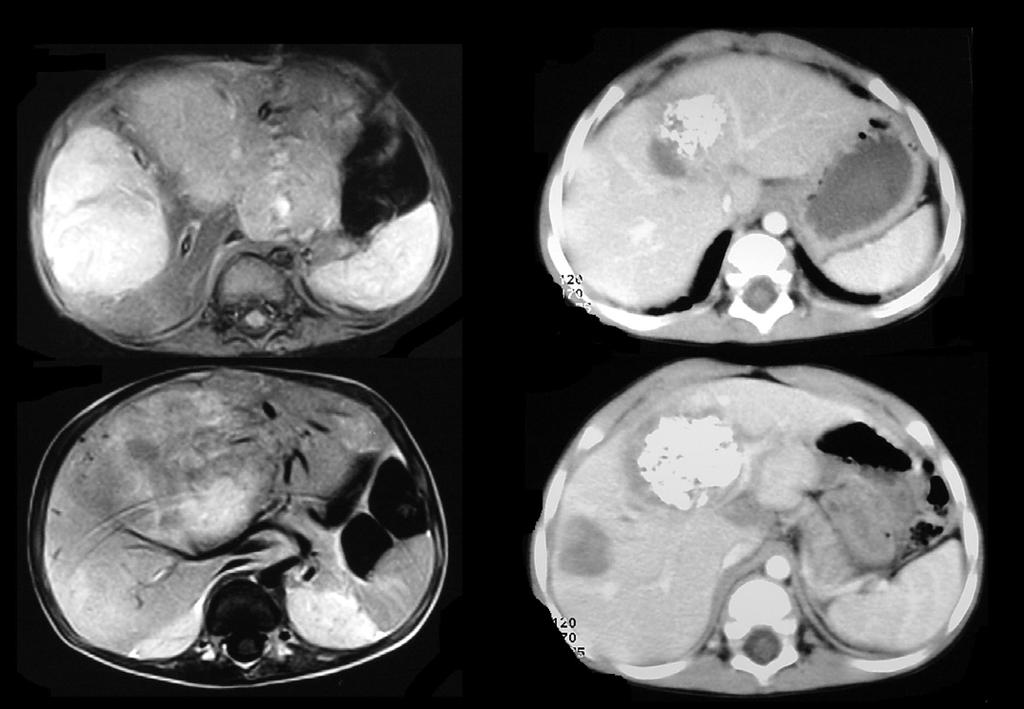 14 month old boy Multifocal liver masses, Pretext 3, No extra-hepatic extension Chemo: