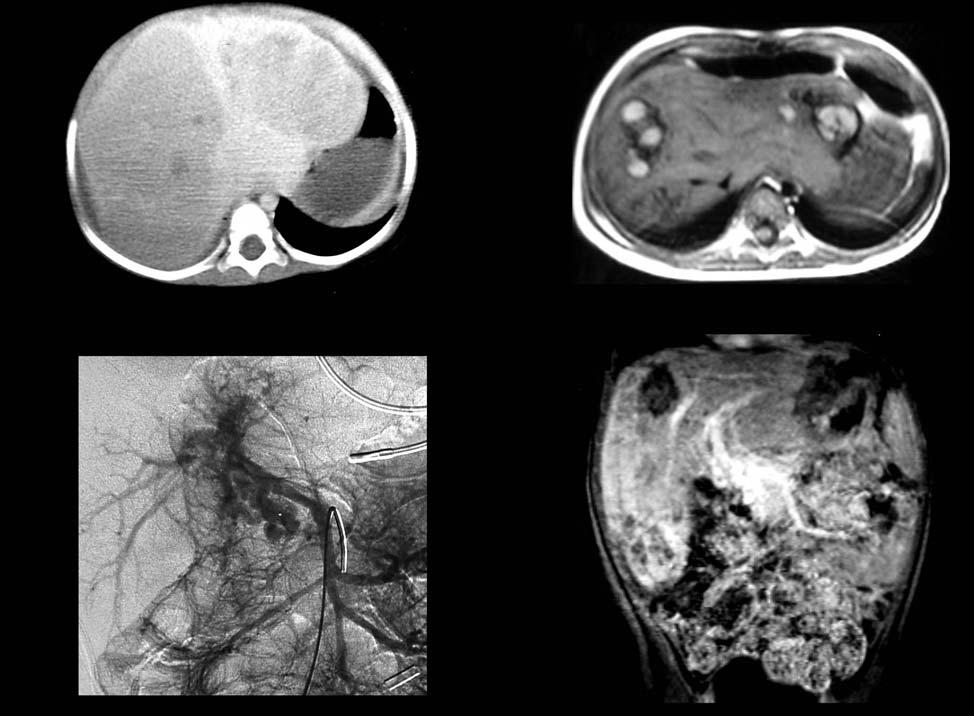 16 month old girl Multifocal liver masses, Pretext 4, Portal vein thrombosis Non