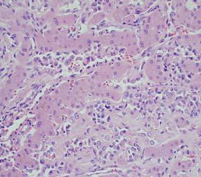 Elastochrome stain: Central vein involvement by tumor