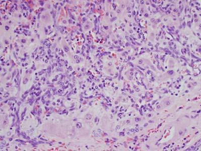 Angiosarcoma Angiosarcoma Scaffolding pattern of growth surrounds hepatocytes Scaffolding pattern of