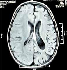 C) Flair image axial section showing porencephalic Cyst, D) T1-weighted image axial section showing lissencephaly (loss of sulci and gyri, smooth