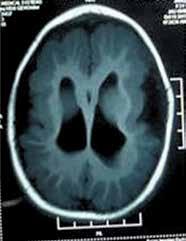 Cerebral Palsy-Clinical Profile and Predisposing Factors. Indian Pediatr 1999;36(10):1038-42. 3. Nelson KB, Ellenberg JH.