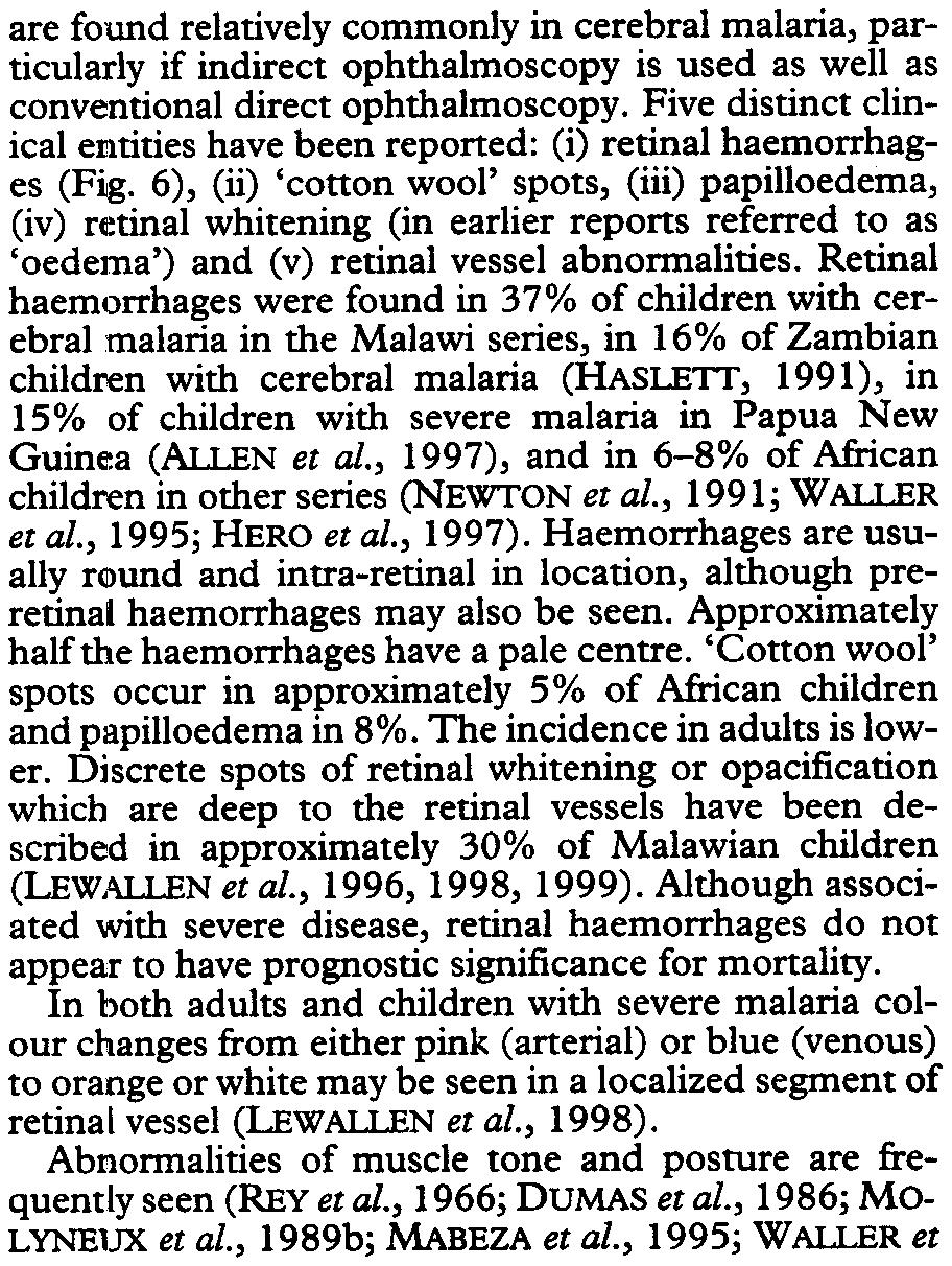 TRANSACTIONS OFTHE ROYAL SOCIETY OFTROPICAL MEDICINE AND HYGIENE (2000) 94, SUPPLEMENT 1 SIn Fig. 6. Multiple retinal haemorrhages in a child with cerebral malaria. (i1:)k. Marsh.
