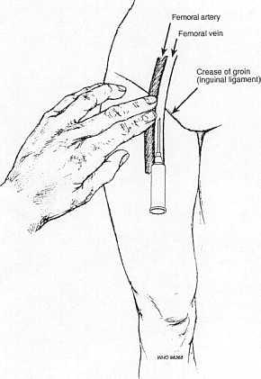 Puncture the skin just medial to the femoral artery) just below the groin crease) and) with the cannula assembly at an angle of 45") advance gently, aspirating repeatedly until the vein is entered