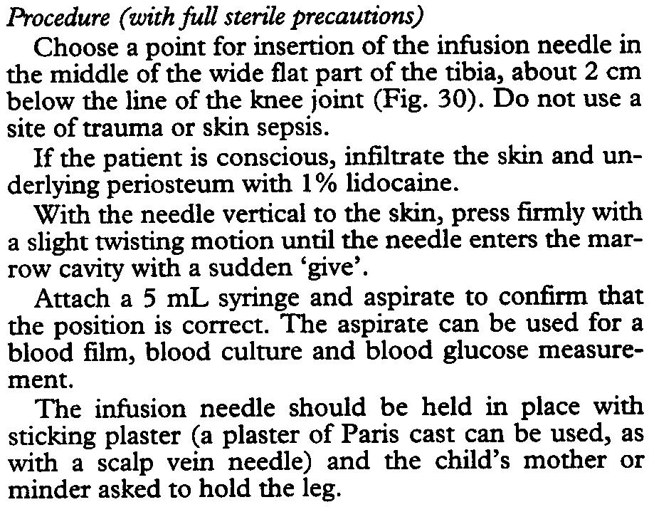 TRANSACnONS OFTHE ROYAL SOCIETY OF TROPICAL MEDICINE AND HYGIENE (2000) 94, SUPPLEMENT S1/71 ANNEXS Setting up an intra-osseous infusion in children If intravenous access is impossible, an