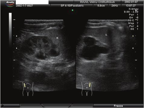 Vertinant naujagimio hidronefrozės laipsnius dažniausiai naudojama Vaisiaus urologų draugijos (the Society of Fetal Urology, SFU) pasiūlyta hidronefrozės klasifikacijos pagal laipsnius sistema, (2