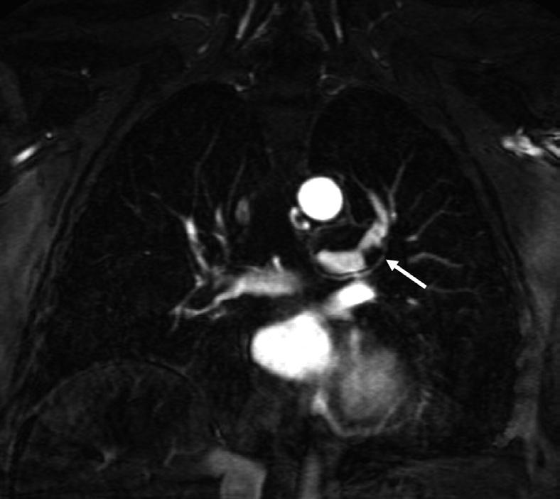 MRI and CT developments in imaging of venous thromboembolism 45 Figure 1. Coronal image from MRA shows focus of low signal (arrow) in the left main pulmonary artery consistent with pulmonary embolism.