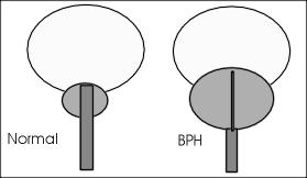 (BPH) Enlarged prostrate leads to difficulty in urination Alpha-receptor blockers (ie