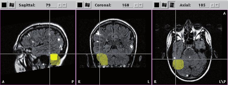 A comparison of high-resolution EEG and MEG Figure 1 Example of source localisation. Integration of EEG (A) and MEG (B) sources in a 3D FLAIR MR image. The crosshair indicates the tuber.