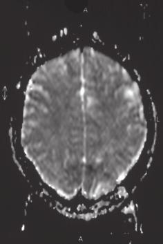 map (B) of patient 2 showing  The epileptogenic tuber