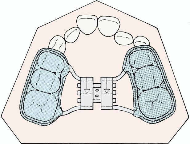 20 O Grady et al American Journal of Orthodontics and Dentofacial Orthopedics August 2006 Fig 1. Acrylic splint rapid maxillary expander. Fig 2. Removable mandibular Schwarz appliance.