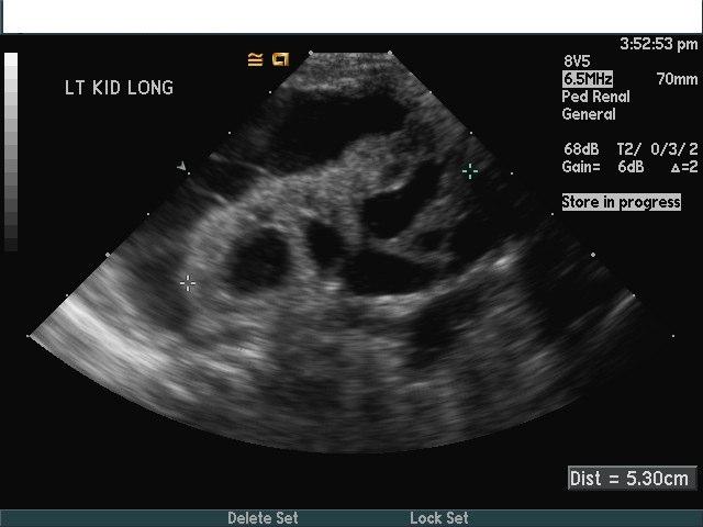 The tools used to diagnose PUV in children include renal US to evaluate for the degree of hydronephrosis, bladder wall thickening, and the general health of the kidneys (Fig. 1).