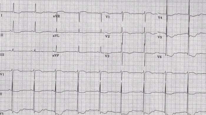 HypoKalemia U wave EKG shows a long QT interval, ST depression, low T waves, and TU wave fusion