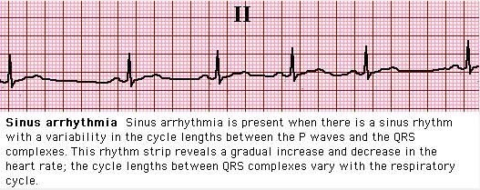 Sinus arrhythmia Rate increases with