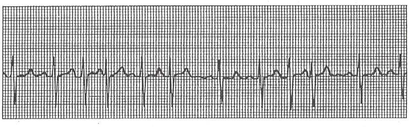 Premature Atrial Beats QRS < 120 ms The interval between the second sinus beat and the ectopic beat is shorter than the interval between the first two sinus beats.