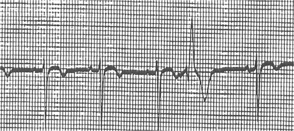 PAC with Aberrancy vs VPB RBBB pattern (rsr ) of the anomalous beats in a right sided monitor lead (V1) An initial deflection