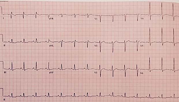Case #3 What is the QRS axis?