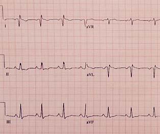 Left and right arm limb leads are reversed If negative p wave and negative QRS complex in Lead I,
