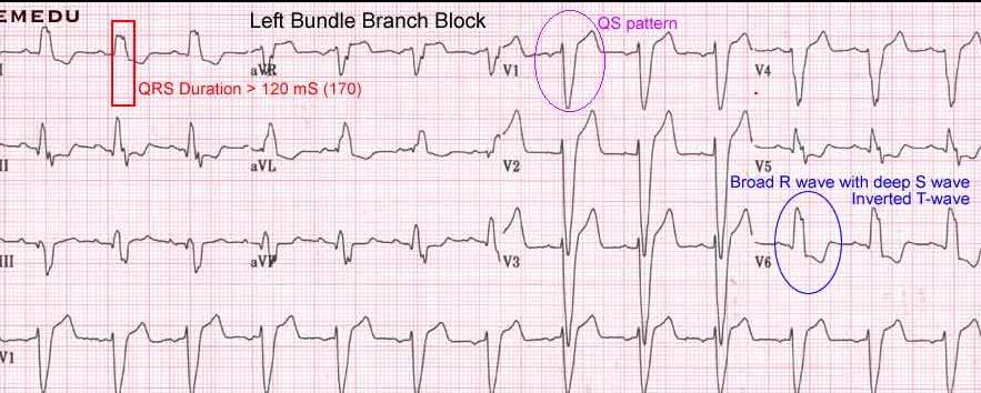 Left Bundle Branch Block rs pattern Terminal S wave in V1 indicating late posterior