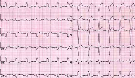 Left Bundle Branch Block QS pattern Terminal S wave in V1 indicating late posterior